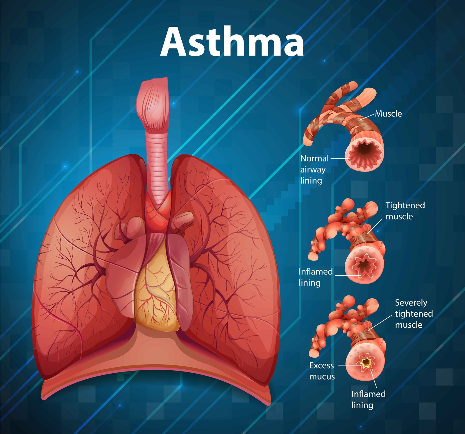 Asthma Causes and Prevention : Protect Your Lungs Today Asthma Causes and Prevention : Protect Your Lungs Today