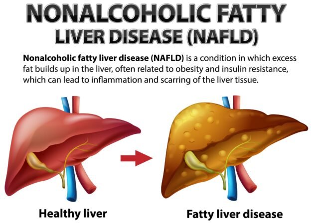 NASH : The Silent Liver Killer NASH : The Silent Liver Killer