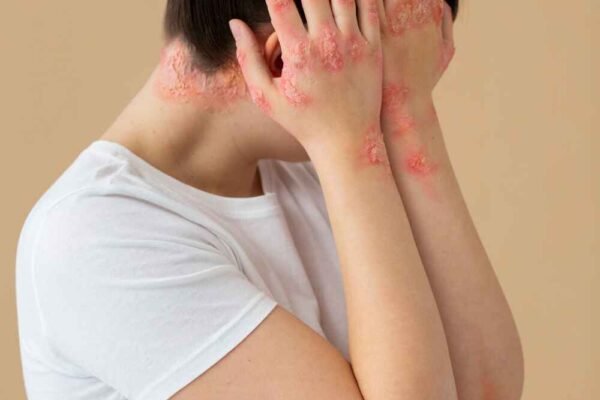 Psoriasis : Preventing and Coping with Flare-Ups Psoriasis : Preventing and Coping with Flare-Ups